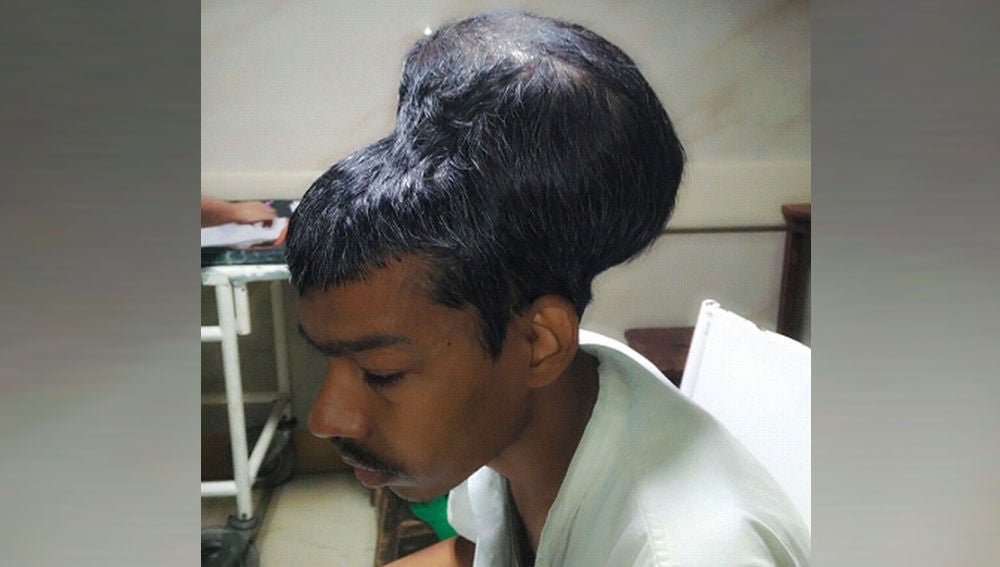 Imagen del hombre operado en La India de un tumor de casi dos kilos