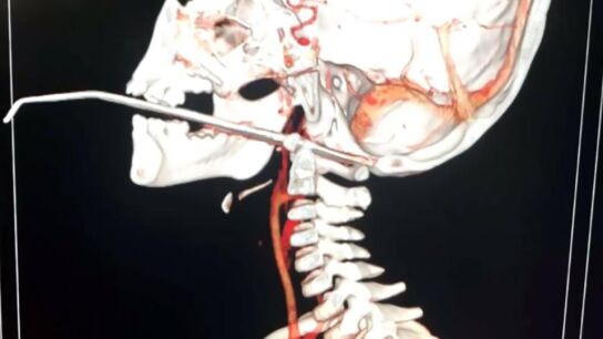Una aguja atraviesa la garganta de un ni&ntilde;o en China