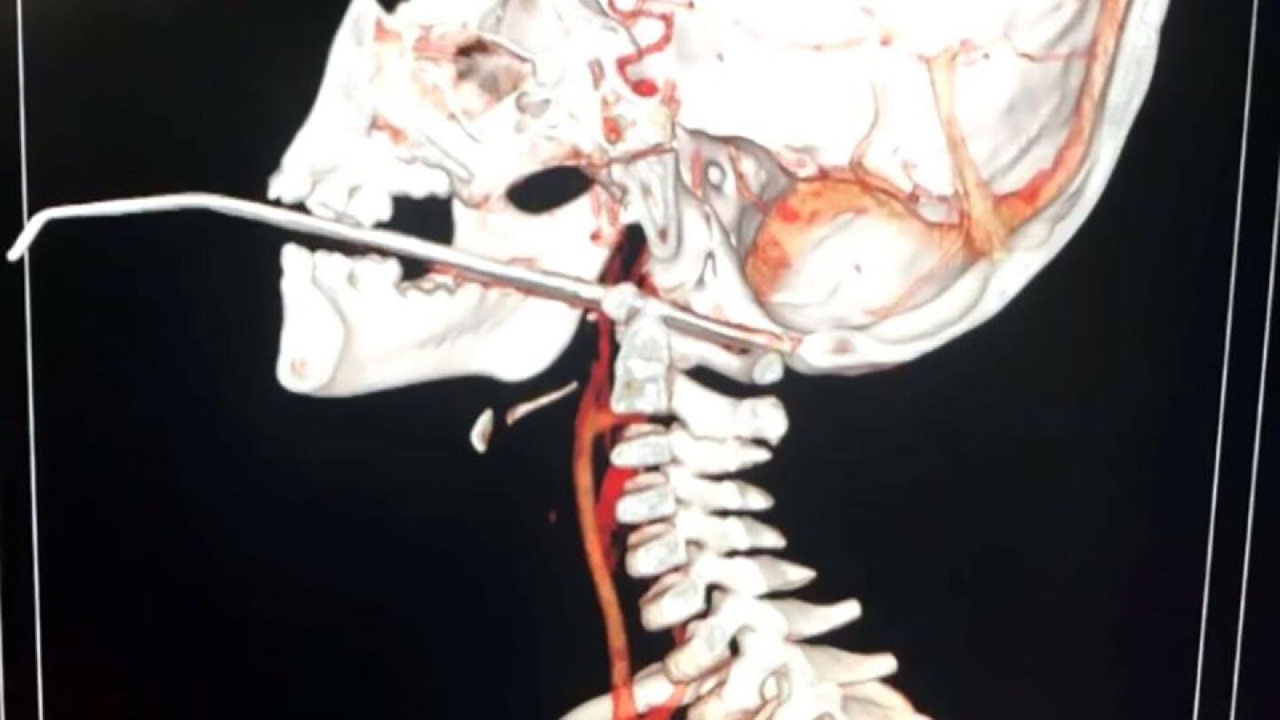 Una aguja atraviesa la garganta de un ni&ntilde;o en China