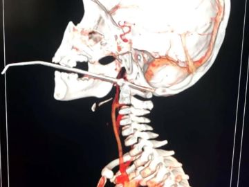 Una aguja atraviesa la garganta de un niño en China Una aguja atraviesa la garganta de un niño en China