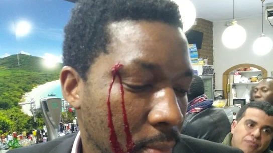 El actor muestra un corte en la ceja tras el ataque racista en Madrid El actor muestra un corte en la ceja tras el ataque racista en Madrid