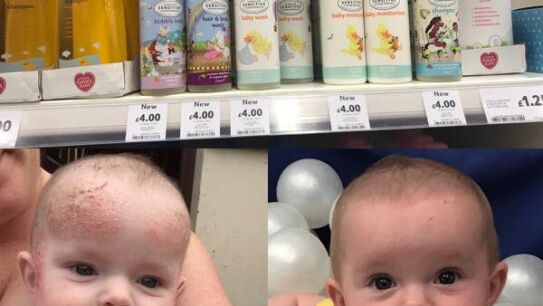 Una madre descubre una crema de beb&eacute;s de 4 euros que cura el eczema infantil y la psoriasis adulta