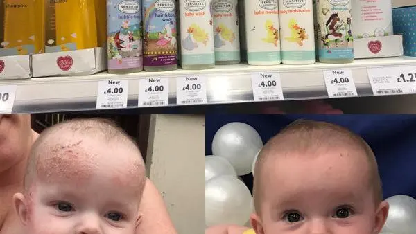 Una madre descubre una crema de bebés de 4 euros que cura el eczema infantil y la psoriasis adulta