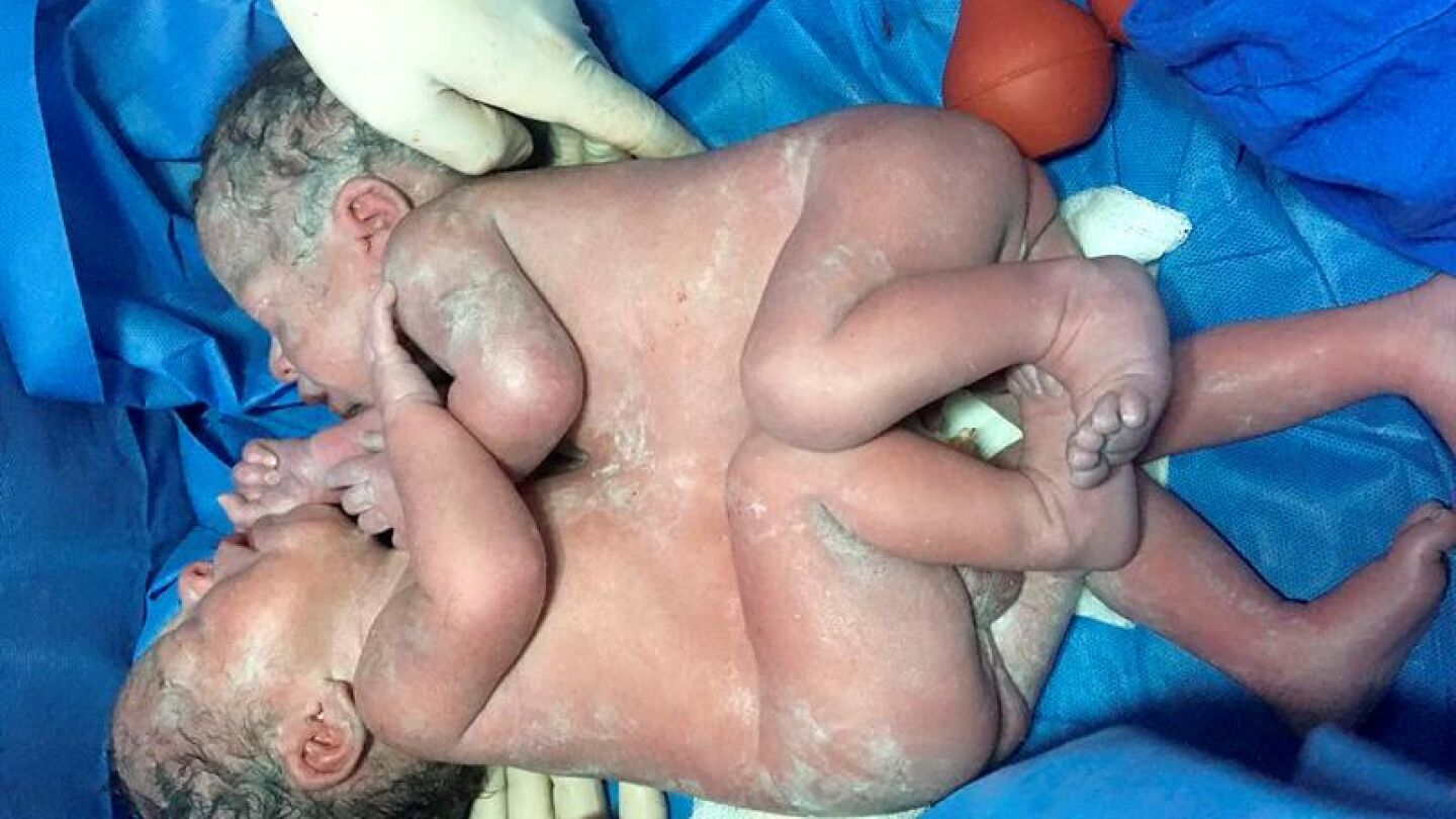 Fotograf&iacute;a cedida por el Instituto Mexicano del Seguro Social (IMSS) que muestra a unos siameses unidos por el t&oacute;rax y el abdomen
