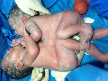 Fotografía cedida por el Instituto Mexicano del Seguro Social (IMSS) que muestra a unos siameses unidos por el tórax y el abdomen Fotografía cedida por el Instituto Mexicano del Seguro Social (IMSS) que muestra a unos siameses unidos por el tórax y el abdomen