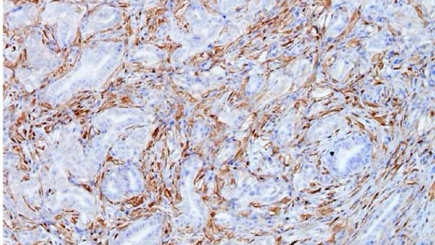 C&eacute;lulas tumorales de c&aacute;ncer de p&aacute;ncreas del modelo Kras del CNIO