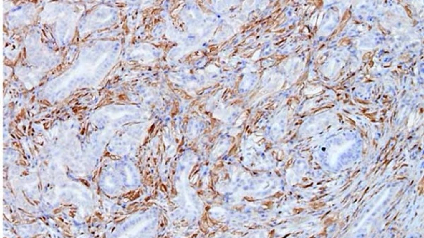Células tumorales de cáncer de páncreas del modelo Kras del CNIO Células tumorales de cáncer de páncreas del modelo Kras del CNIO