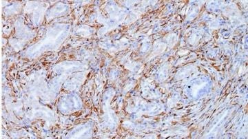 Células tumorales de cáncer de páncreas del modelo Kras del CNIO