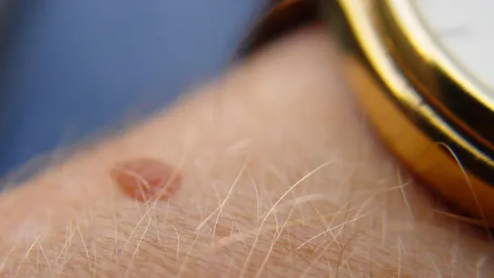 Imagen de un lunar Imagen de un lunar