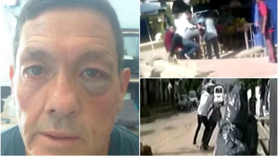 Así quedó el ojo del seleccionador tras la pelea callejera Así quedó el ojo del seleccionador tras la pelea callejera