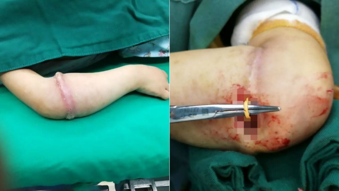 El brazo de la peque&ntilde;a, antes y durante la intervenci&oacute;n
