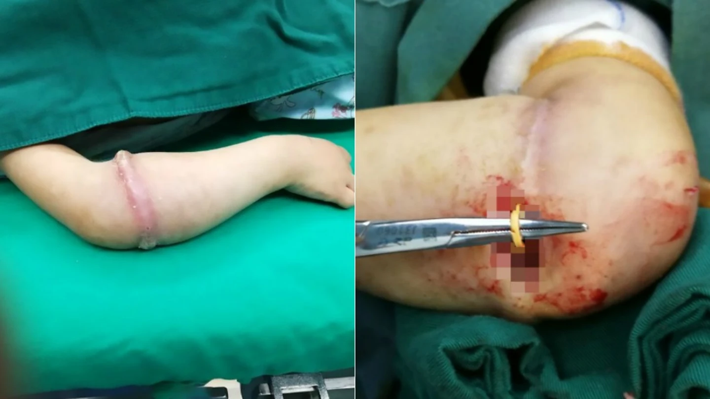 El brazo de la pequeña, antes y durante la intervención El brazo de la pequeña, antes y durante la intervención