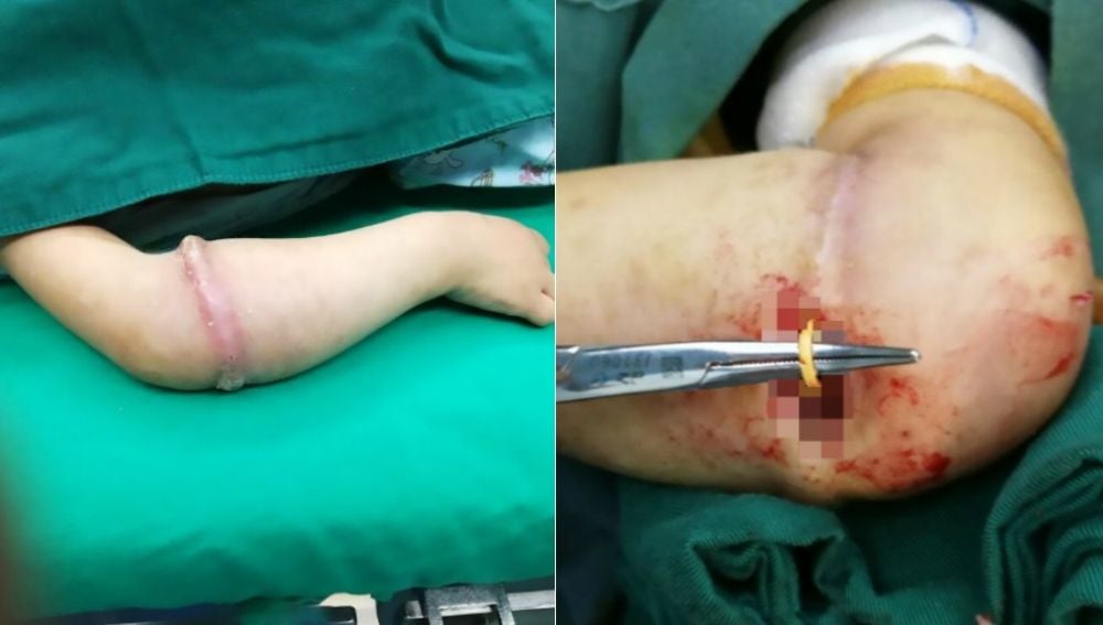 El brazo de la pequeña, antes y durante la intervención