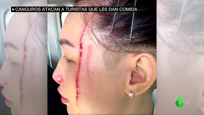 Una turista herida por el ataque de un canguro en Australia Una turista herida por el ataque de un canguro en Australia