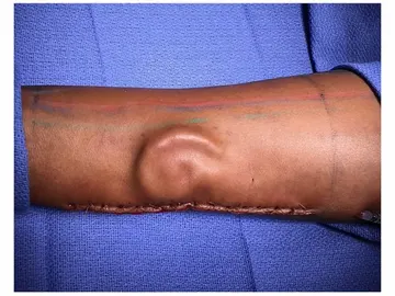 La oreja implantada en el brazo La oreja implantada en el brazo