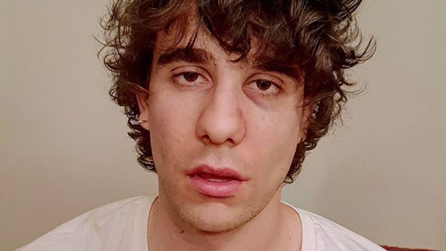 Javier Calvo muestra su cara tras la agresi&oacute;n en Lisboa