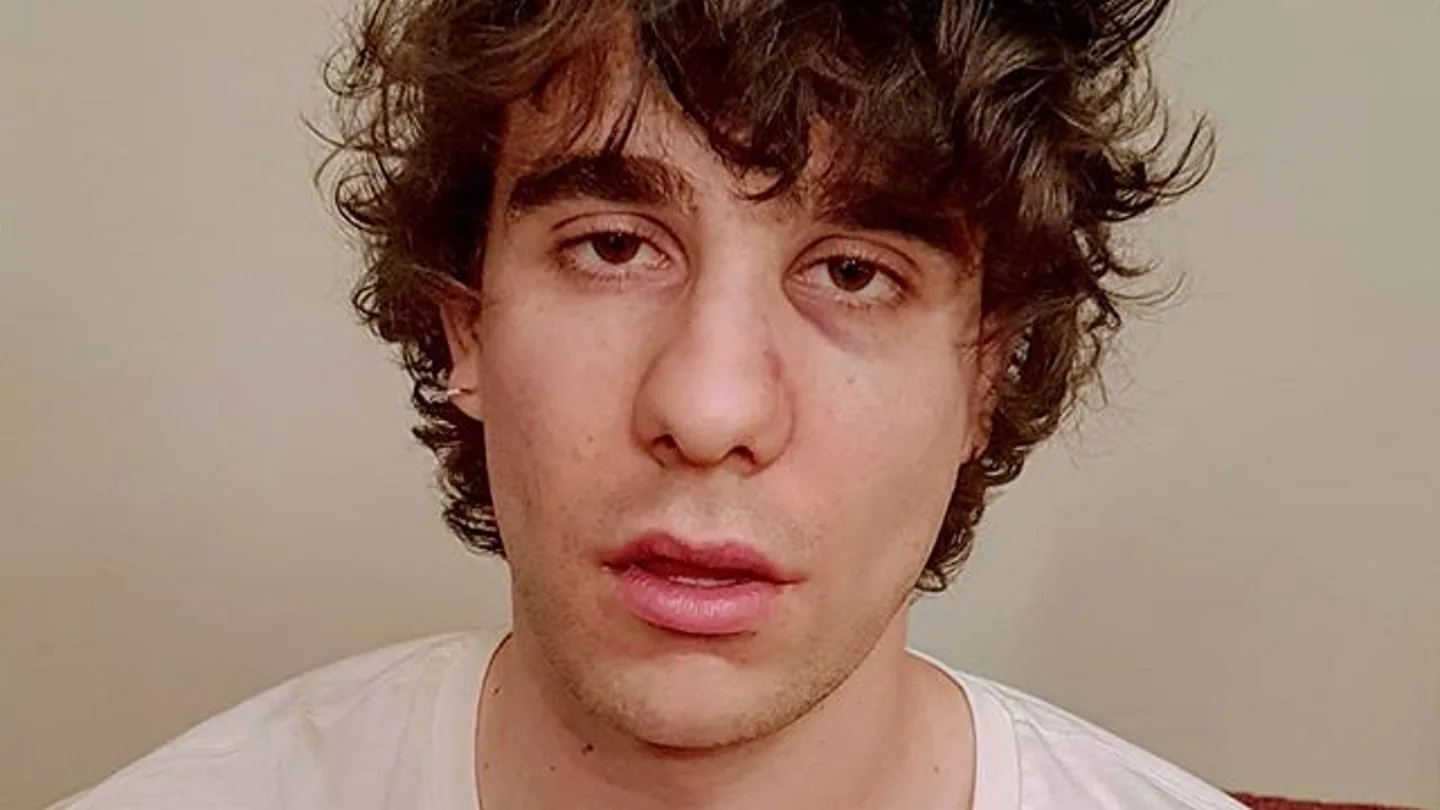 Javier Calvo muestra su cara tras la agresión en Lisboa Javier Calvo muestra su cara tras la agresión en Lisboa