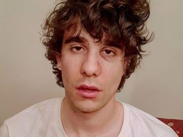 Javier Calvo muestra su cara tras la agresión en Lisboa Javier Calvo muestra su cara tras la agresión en Lisboa