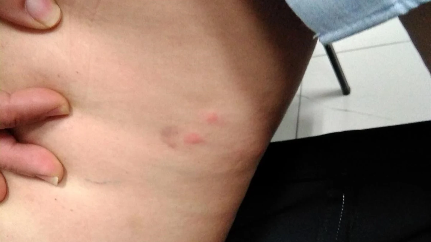Una trabajadora afectada por la plaga de pulgas en el Aeropuerto de Palma Una trabajadora afectada por la plaga de pulgas en el Aeropuerto de Palma