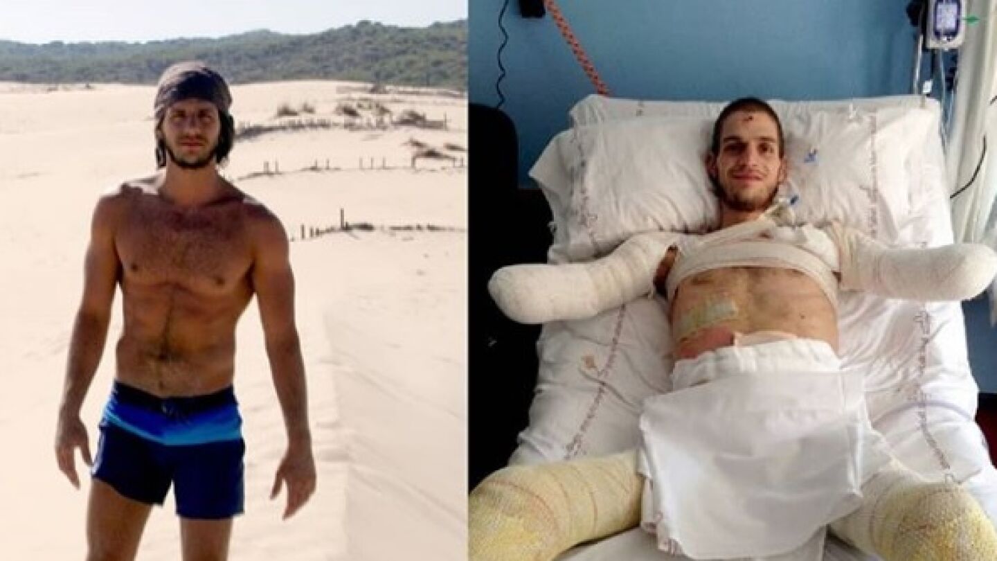 El joven Davide antes y despu&eacute;s de ser amputado