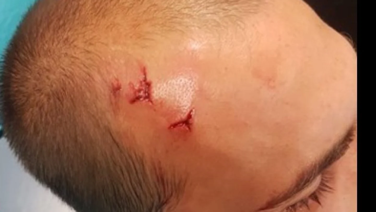 Bas Dost, jugador del Sporting, con una herida en la cabeza Bas Dost, jugador del Sporting, con una herida en la cabeza