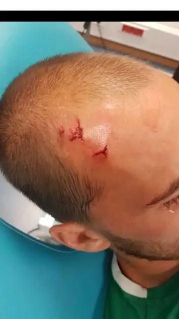Bas Dost, jugador del Sporting, con una herida en la cabeza Bas Dost, jugador del Sporting, con una herida en la cabeza