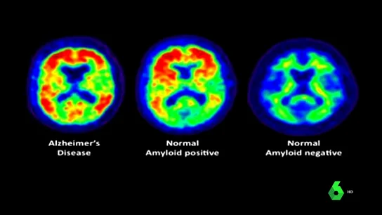 Sufrir apnea del sueño genera más probabilidad de padecer Alzheimer: estos son los pasos para su prevención Sufrir apnea del sueño genera más probabilidad de padecer Alzheimer: estos son los pasos para su prevención