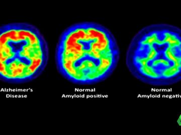 Sufrir apnea del sueño genera más probabilidad de padecer Alzheimer: estos son los pasos para su prevención Sufrir apnea del sueño genera más probabilidad de padecer Alzheimer: estos son los pasos para su prevención