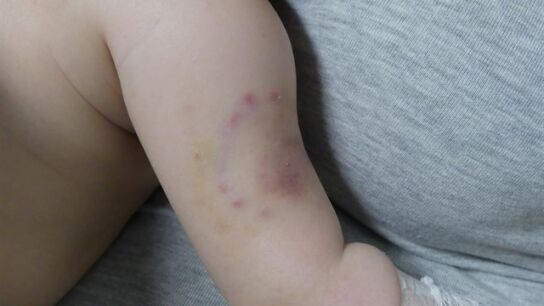 Imagen de los hematomas del beb&eacute;