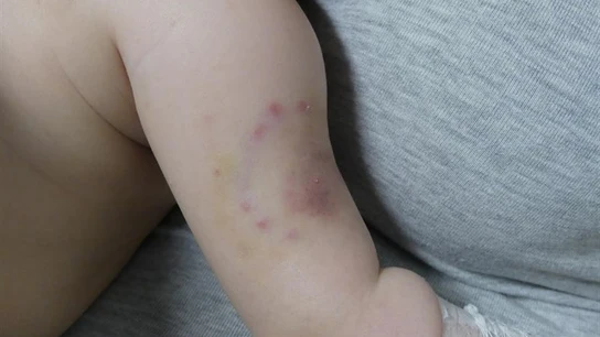 Imagen de los hematomas del bebé Imagen de los hematomas del bebé