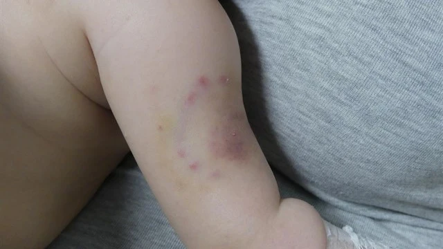 Imagen de los hematomas del bebé