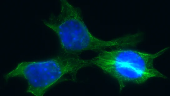 Células de cáncer de mama Células de cáncer de mama