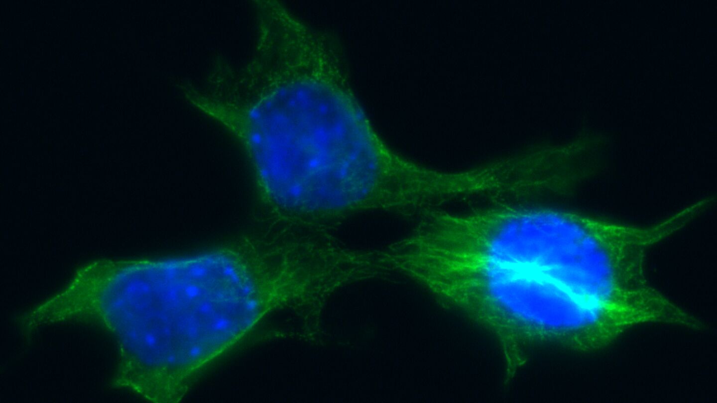 C&eacute;lulas de c&aacute;ncer de mama