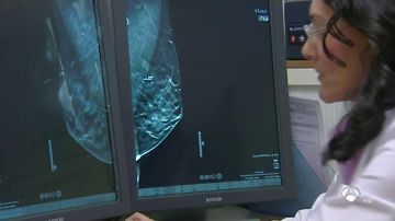Mamografía es la técnica diagnóstica de cáncer de mama