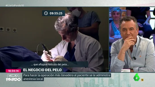 Reportaje de injerto capilar Reportaje de injerto capilar