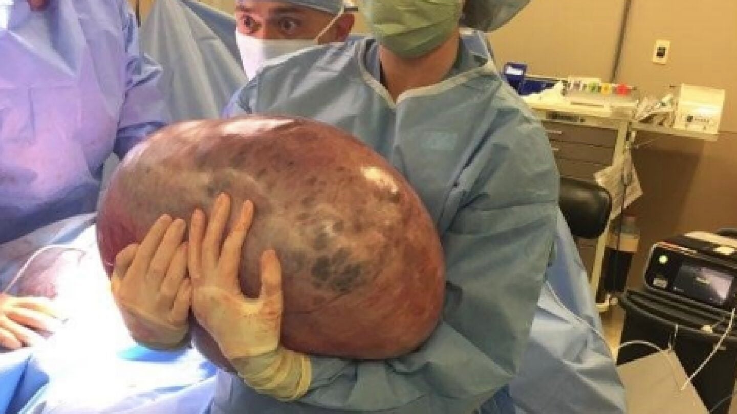 El quiste de 22 kilos extirpado a una joven estadounidense