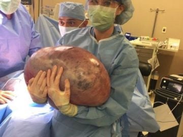 El quiste de 22 kilos extirpado a una joven estadounidense