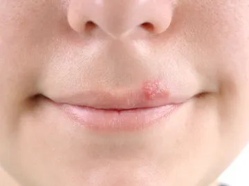 Aparición de una calentura o herpes labial Aparición de una calentura o herpes labial