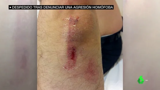 Karim, agredido por ser homosexual y marroquí: "Gracias a mi brazo estoy aquí, si no hubiera sido una muerte segura" Karim, agredido por ser homosexual y marroquí: "Gracias a mi brazo estoy aquí, si no hubiera sido una muerte segura"