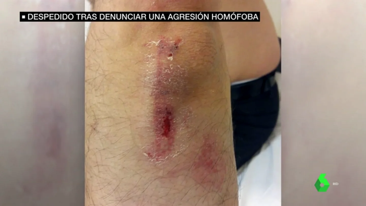 Karim, agredido por ser homosexual y marroquí: "Gracias a mi brazo estoy aquí, si no hubiera sido una muerte segura" Karim, agredido por ser homosexual y marroquí: "Gracias a mi brazo estoy aquí, si no hubiera sido una muerte segura"