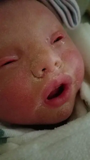 Amelia Moe, niña con 'piel de serpiente'