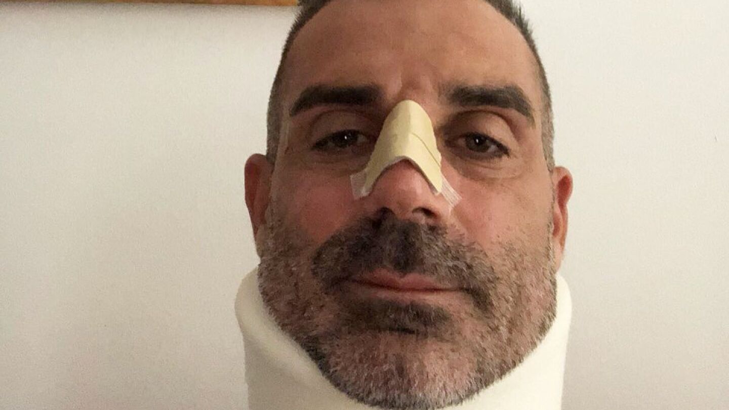 Sorrentino, con la nariz rota