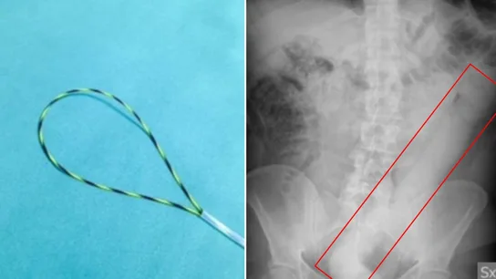 Pene atascado en el intestino Pene atascado en el intestino