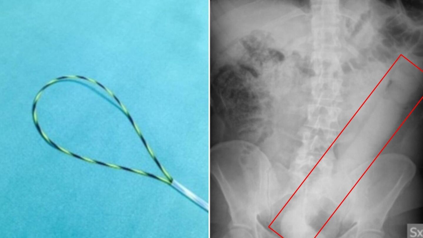 Pene atascado en el intestino
