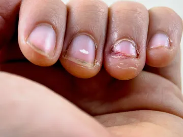 Uñas mordidas Uñas mordidas