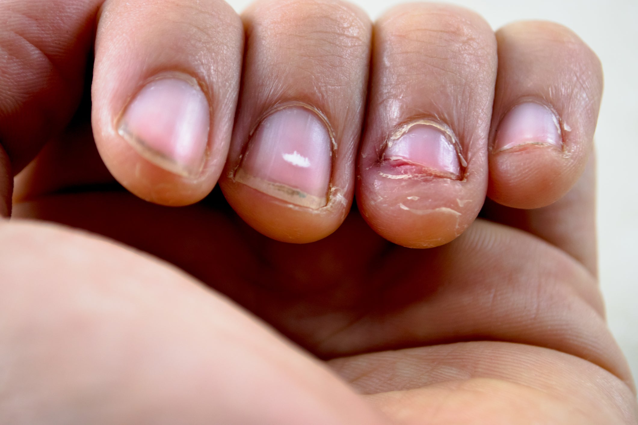 incidente En lo que respecta a las personas amenazar Le amputan el dedo a una joven al desarrollar cáncer por morderse las uñas