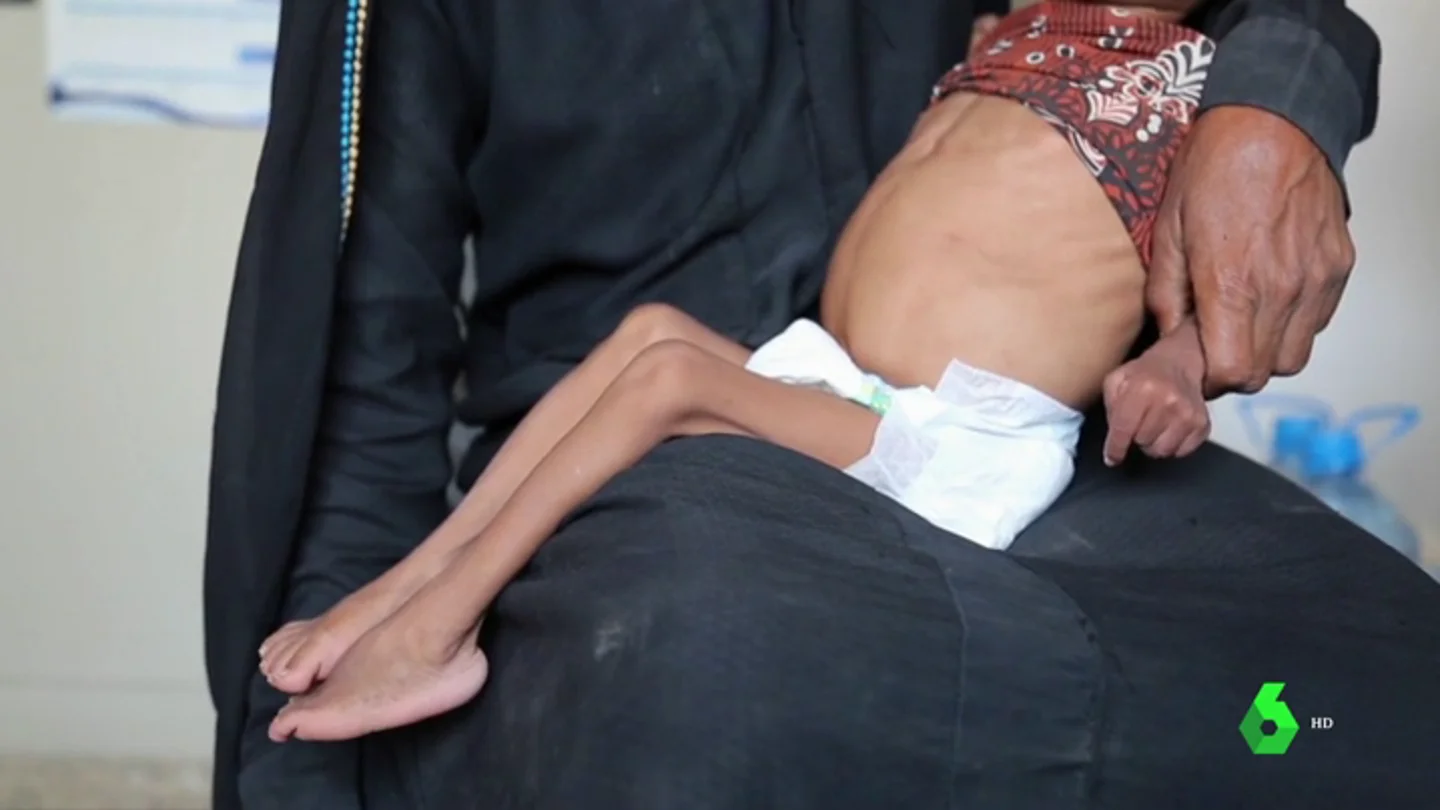 El hambre amenaza a más de cinco millones de niños en Yemen El hambre amenaza a más de cinco millones de niños en Yemen