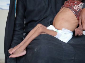 El hambre amenaza a más de cinco millones de niños en Yemen El hambre amenaza a más de cinco millones de niños en Yemen
