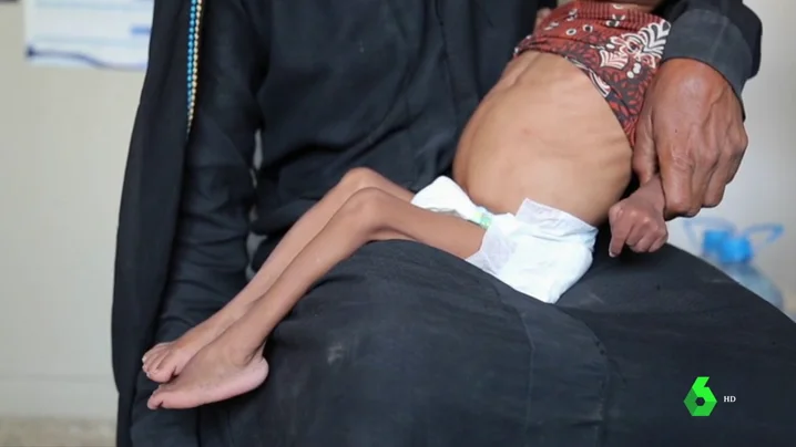 El hambre amenaza a más de cinco millones de niños en Yemen