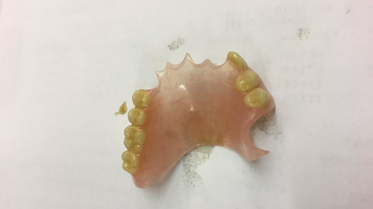 Dentadura postiza